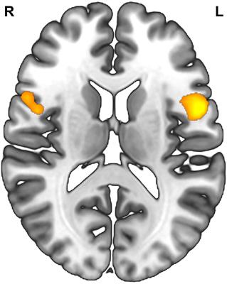 Inferior Frontal Gyrus-Based Resting-State Functional Connectivity and Medium Dispositional Use of Reappraisal Strategy